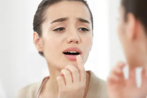 The Easiest and Most Effective Home Remedies To Hasten the Healing of Cold Sores